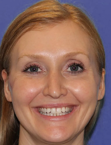 botox-after