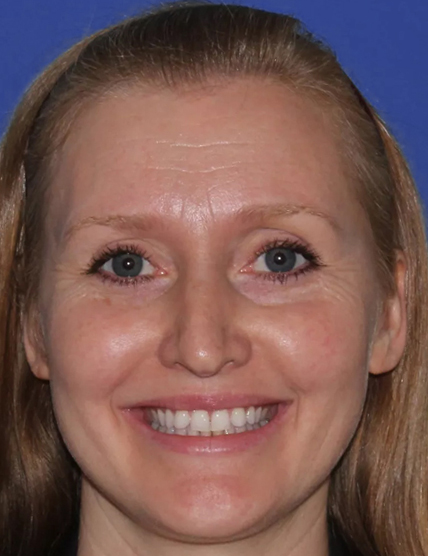 botox-before